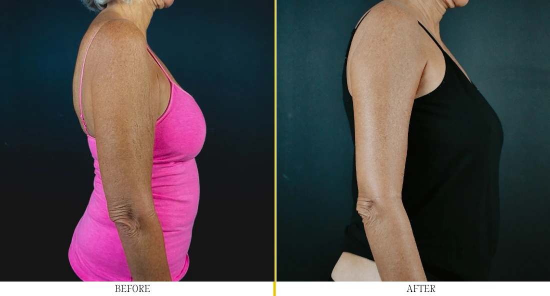 Before and after brachioplasty showing improved arm contour and skin tightness from side view