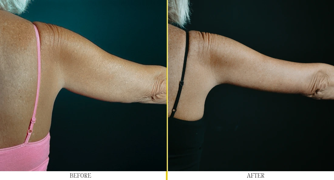 Before and after brachioplasty showing reduced arm laxity and improved upper arm definition
