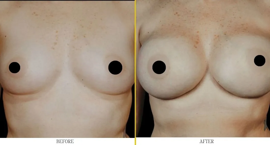 Breast augmentation before and after comparison, labeled before on left and after on right