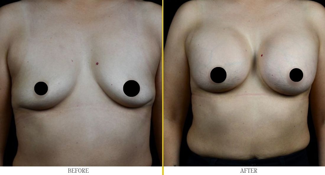 breast-lift-case-4