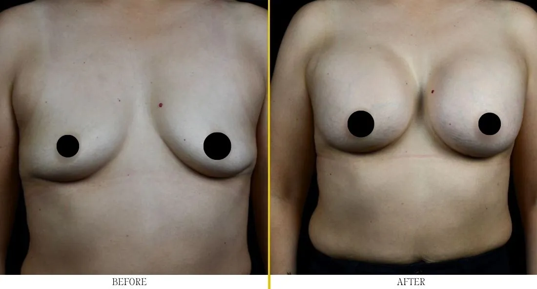 Front view before and after breast lift showing lifted breast position and enhanced shape