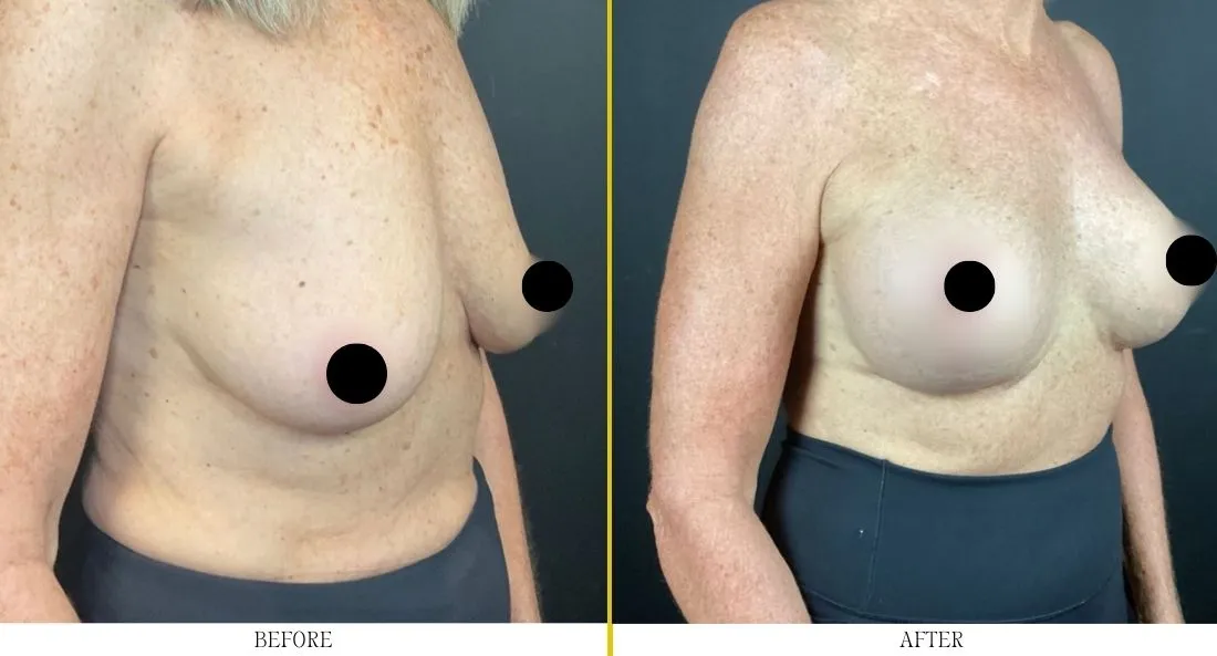 Side view before and after breast lift showing improved breast projection and contour