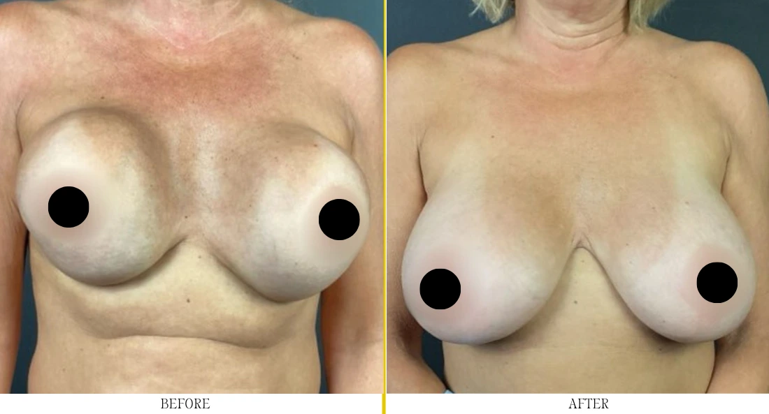 Before and after breast reconstruction showing improved breast symmetry and contour