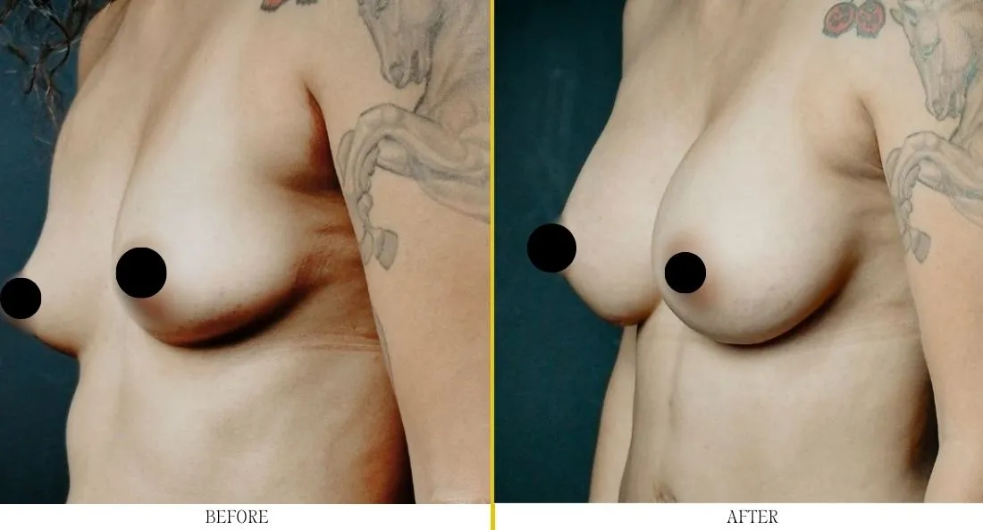 Before and after breast lift case showing improved breast contour and positioning