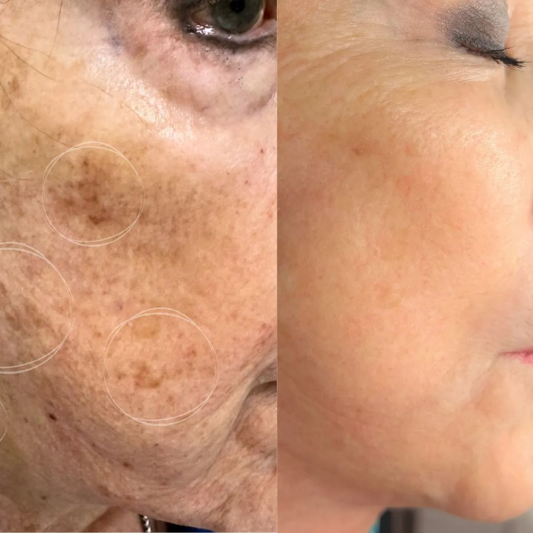 Close-up before and after broadband light treatment showing reduction in brown spots on cheek