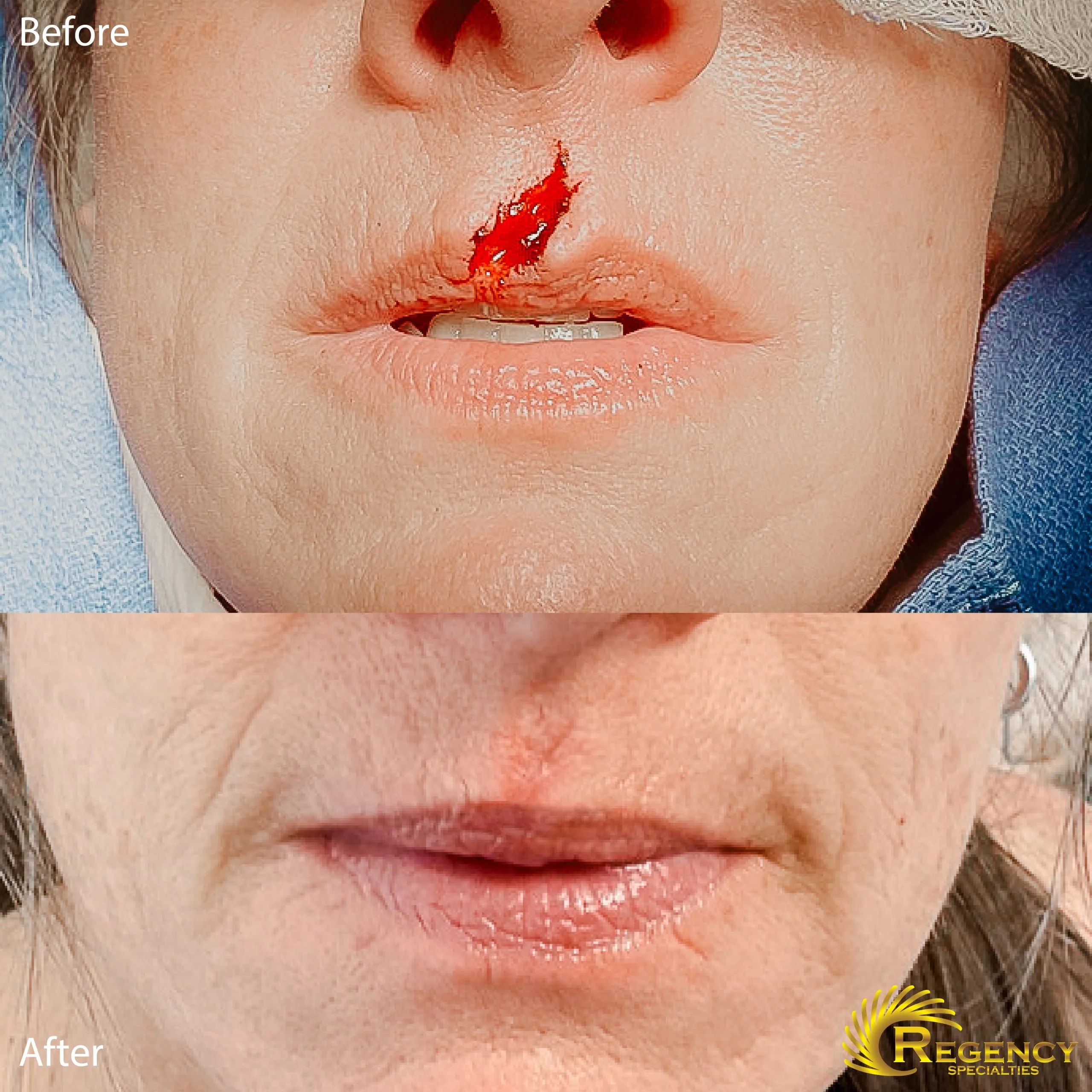 Mohs surgery case before showing lesion on upper lip and after showing healed result