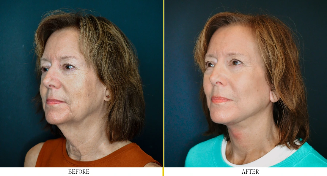 Woman's face in profile before and after facelift, showing improved jawline definition and skin tightness