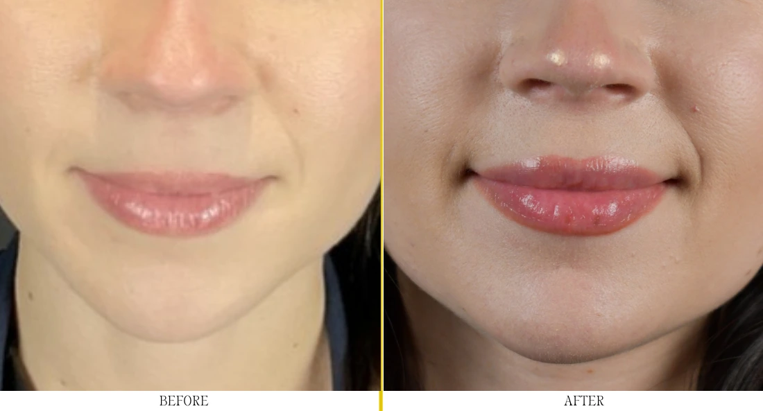 Close-up of lips before and after filler treatment, showing increased volume and fullness