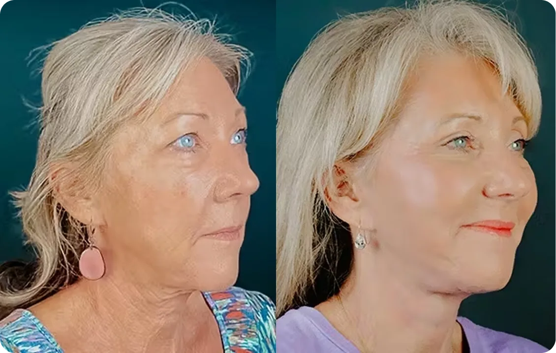 Before and after profile view of woman showing improved jawline definition and skin appearance