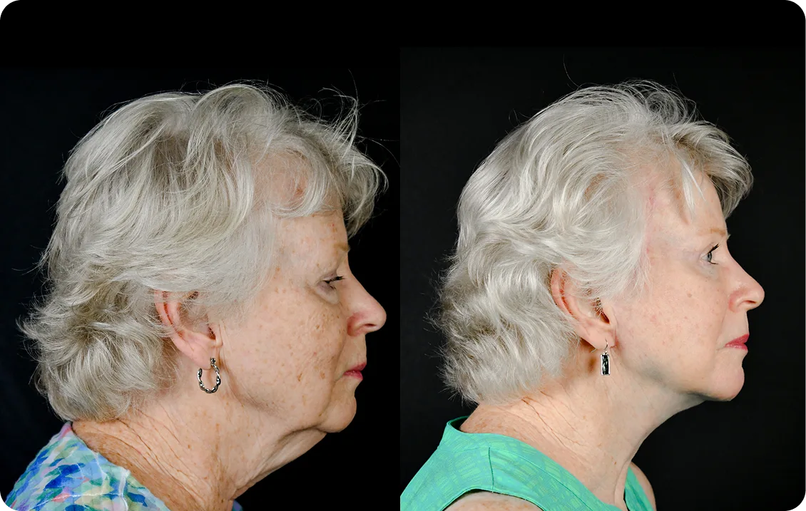 Before and after side profile view of woman showing enhanced facial contours and neck definition