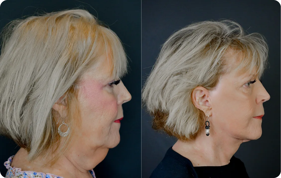 Before and after profile view of woman showing improved skin firmness and facial rejuvenation results