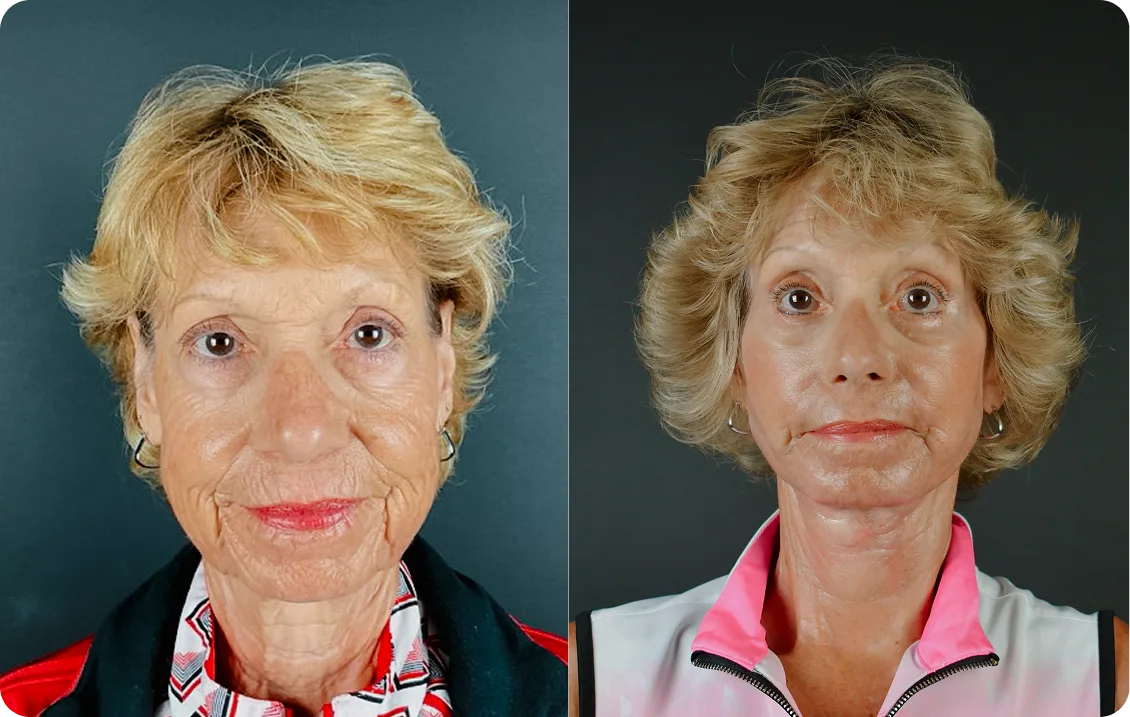 Before and after facial appearance, frontal view