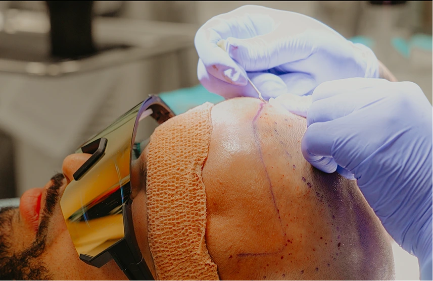 Gloved practitioner performing laser treatment on patient's shoulder with protective eyewear