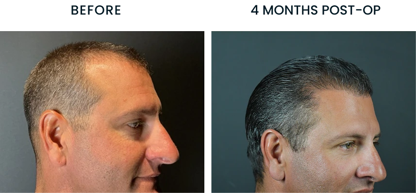 Before and after profile comparison of male patient, showing results 4 months post-op