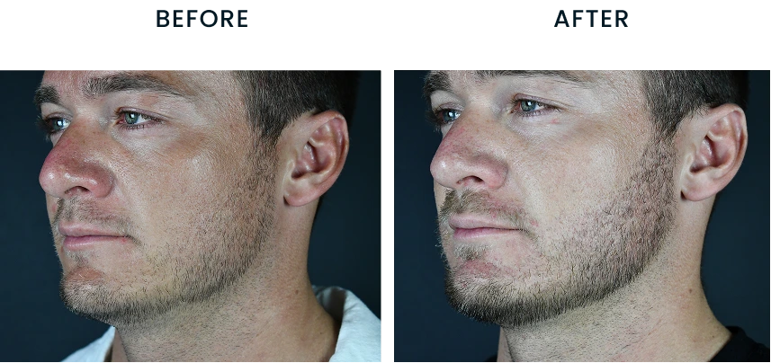 Facial profile before and after comparison showing chin and jawline definition improvement