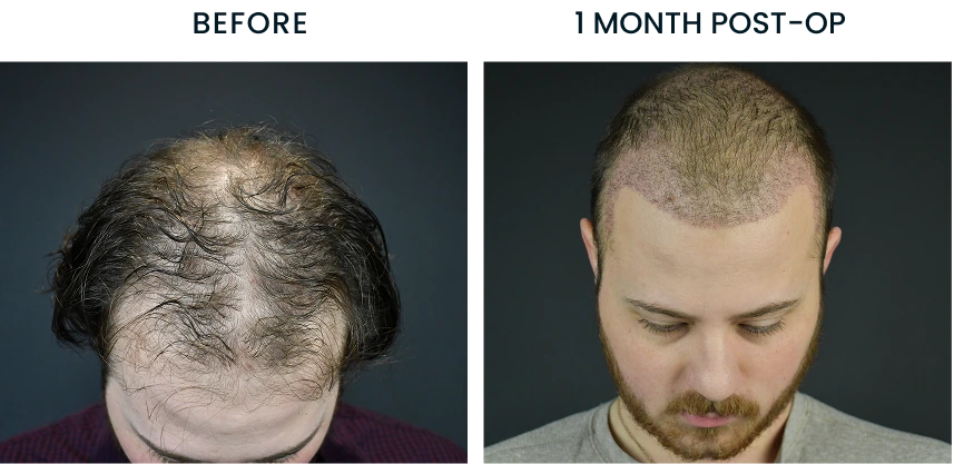 Hair restoration before and 1 month post-op comparison of male patient's head from back view