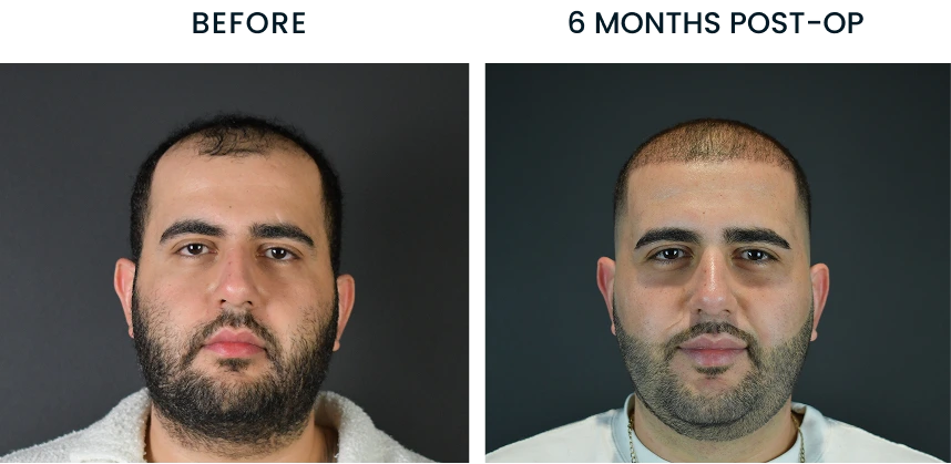 Hair restoration before and 6 months post-op comparison of male patient's head from front view