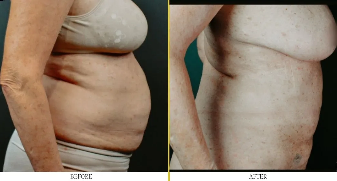 Side profile before and after liposuction showing abdominal contouring results