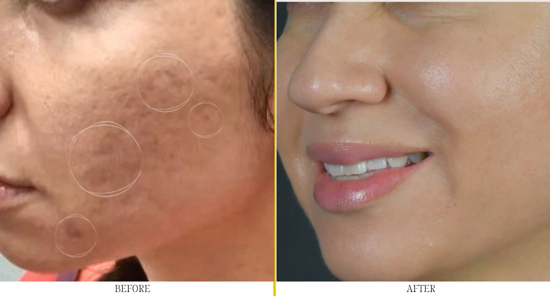 Woman's cheek with acne scarring before microneedling and smoother, refined skin texture after treatment