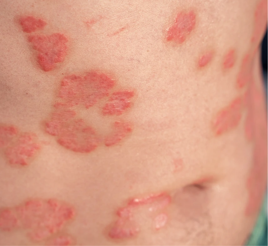 Phoenix, AZ Psoriasis Care Banner