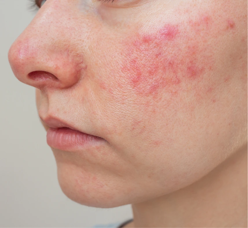Phoenix, AZ Rosacea Treatment Banner