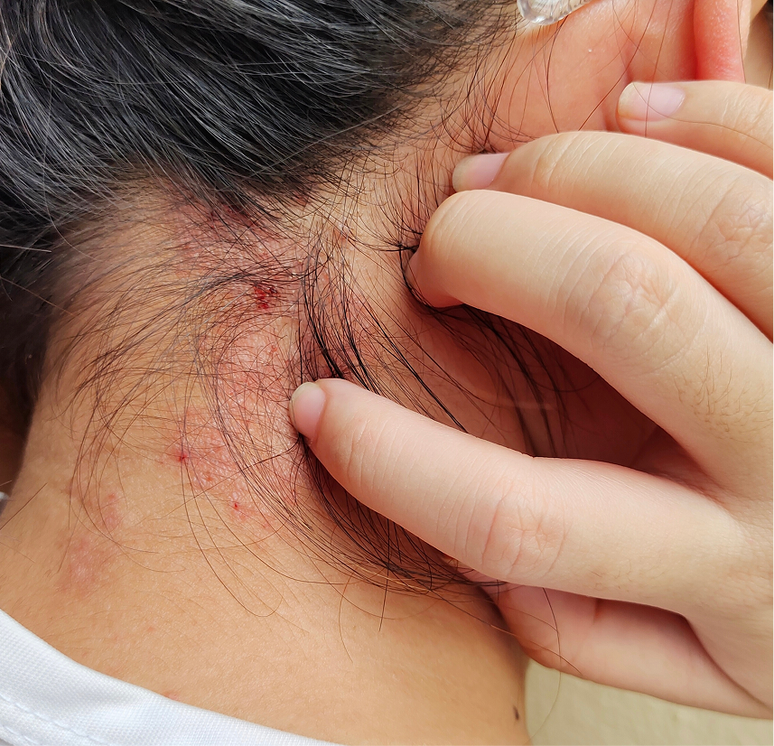 Psoriasis Management in Phoenix, Arizona Banner