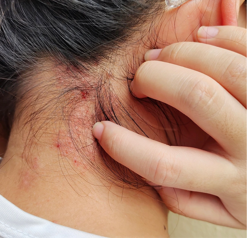 Psoriasis Management in Phoenix, Arizona Banner