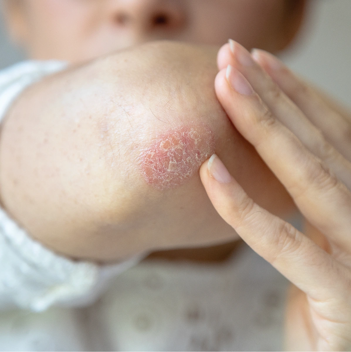 Psoriasis Treatment in Phoenix, AZ Banner