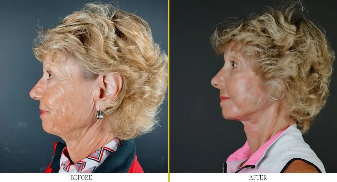 Before and after Regency Lift procedure showing profile view with enhanced skin tightness