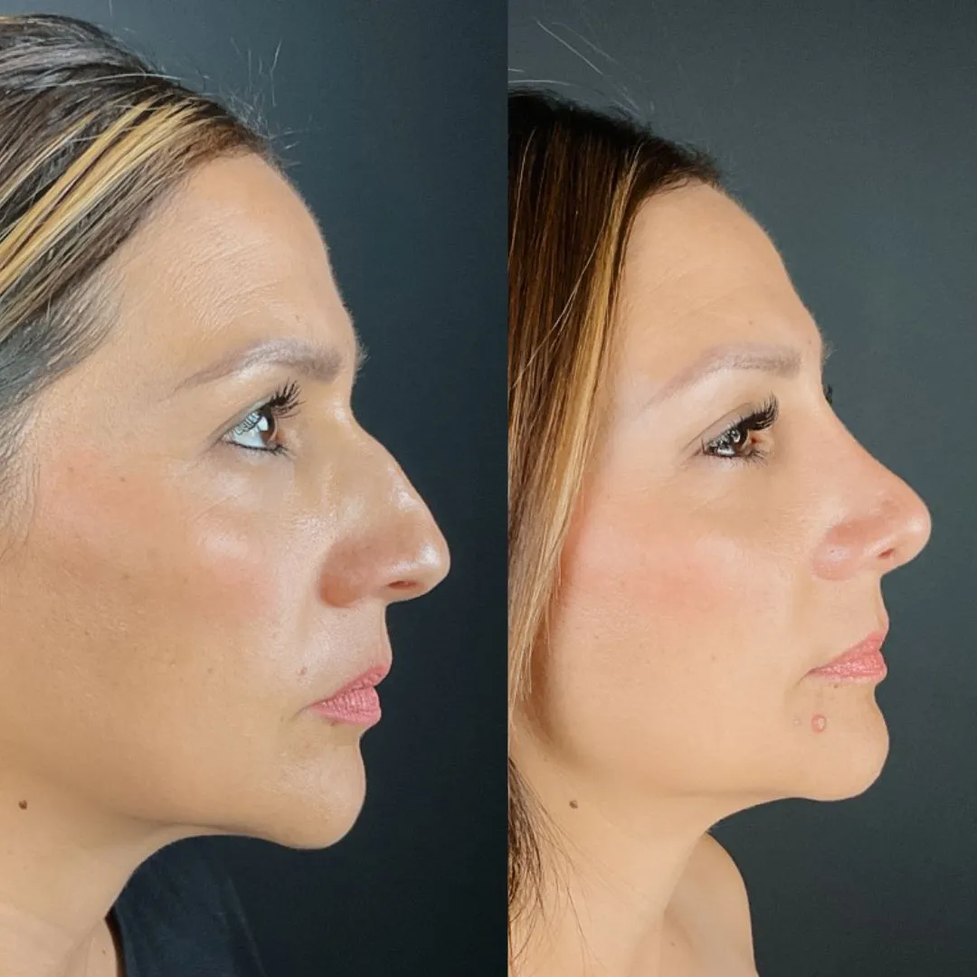 Rhinoplasty before and after, profile view showing nose shape change