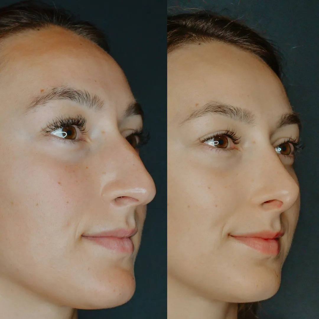 Rhinoplasty before and after, profile view showing nasal refinement