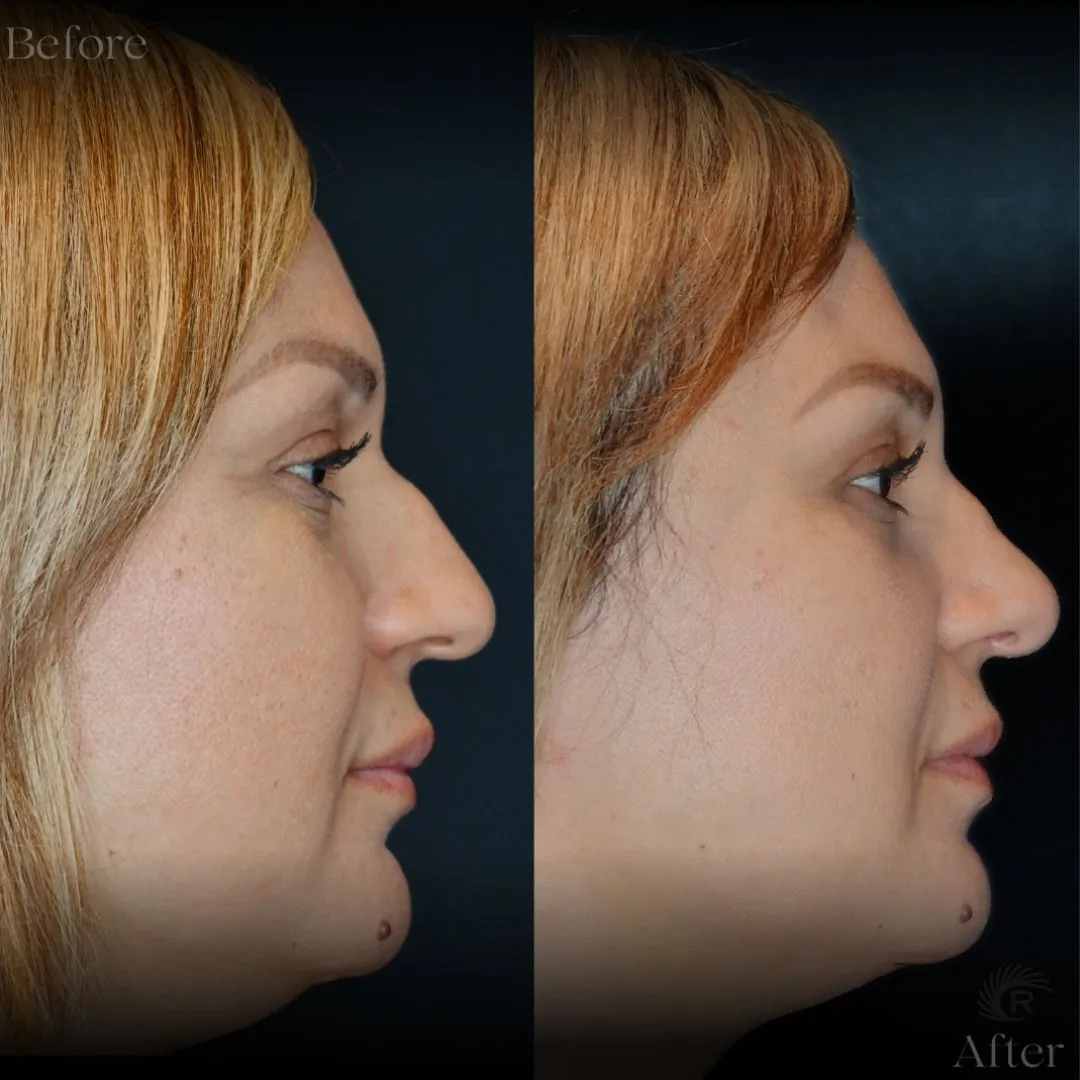 Side profile before and after rhinoplasty showing refined nasal bridge and tip