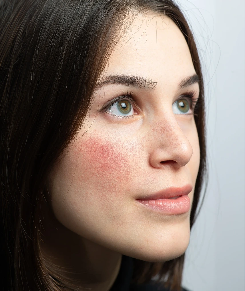 Rosacea Therapy in Phoenix, AZ Banner