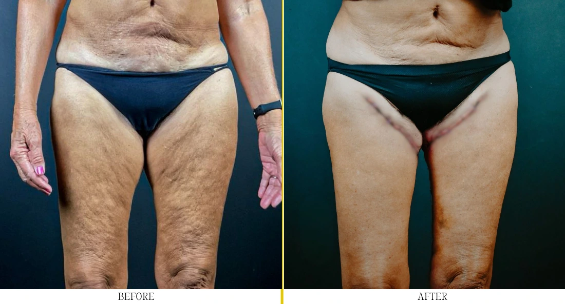 Before and after thigh lift showing reduced skin laxity and improved thigh contour