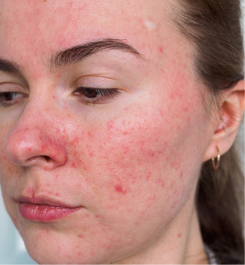 Treatment for Rosacea Phoenix, AZ Banner