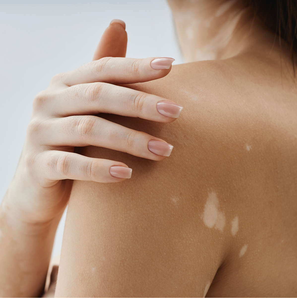 Vitiligo Care in Phoenix, AZ Banner