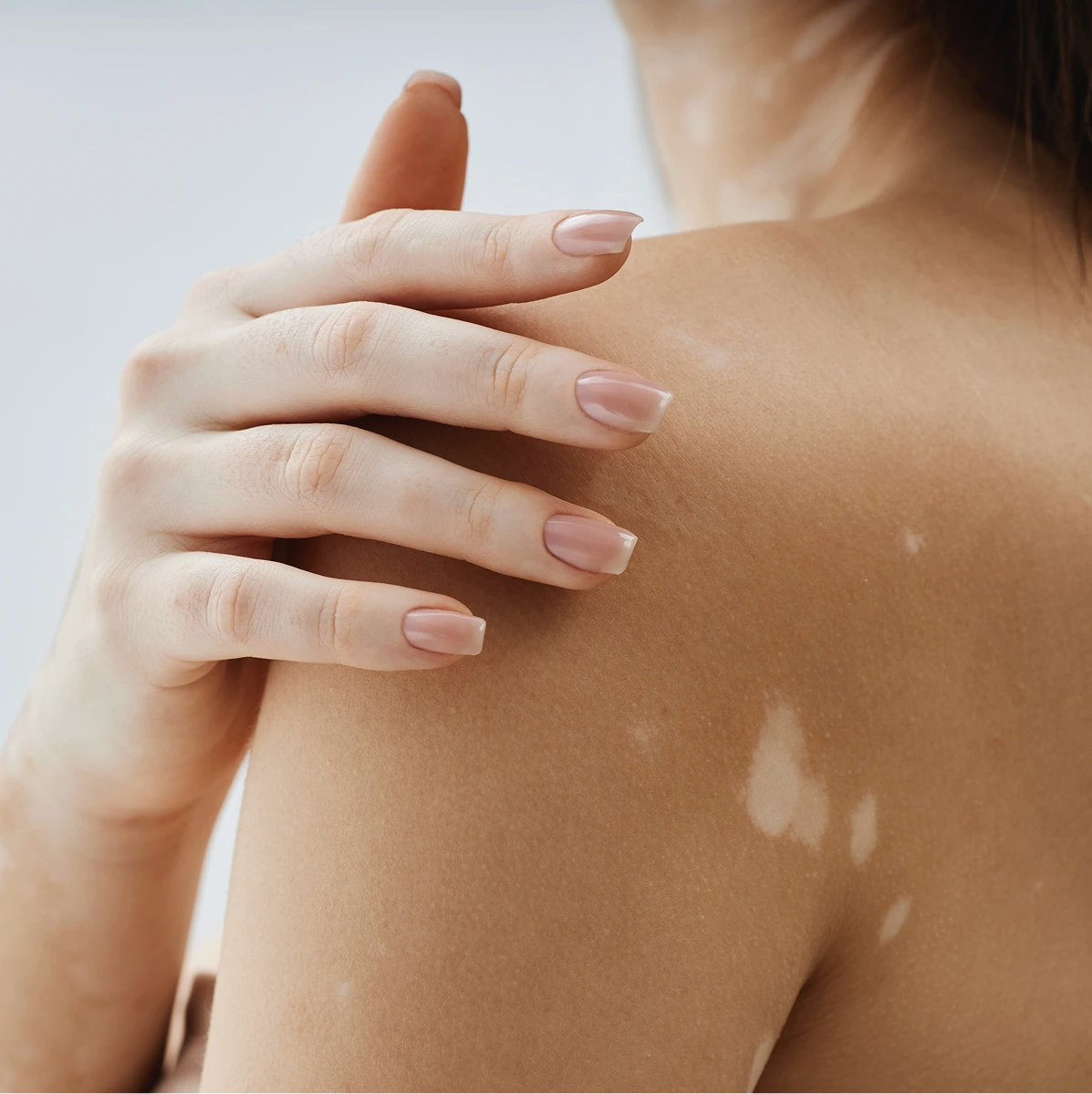 Vitiligo Care in Phoenix, AZ Banner