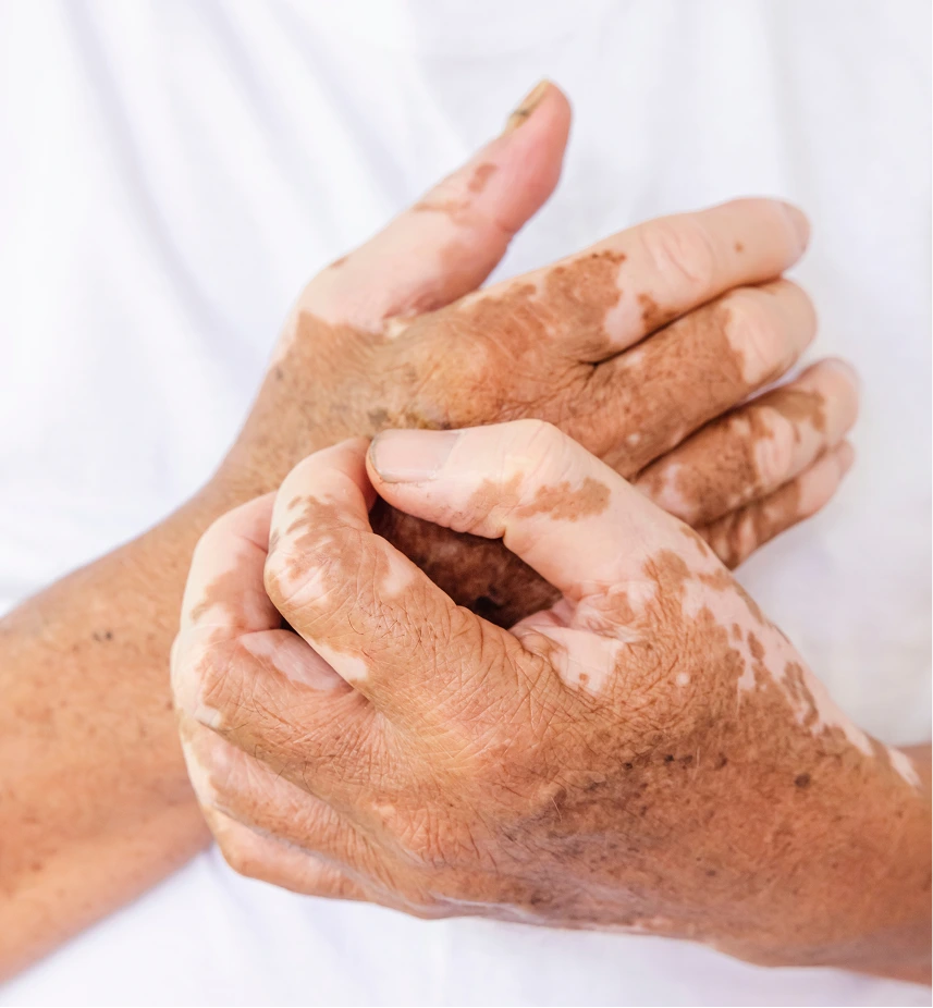 Vitiligo Skin Treatment in Phoenix, AZ Banner
