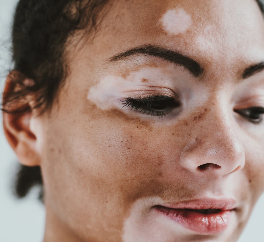 Vitiligo Therapy in Phoenix, AZ Banner