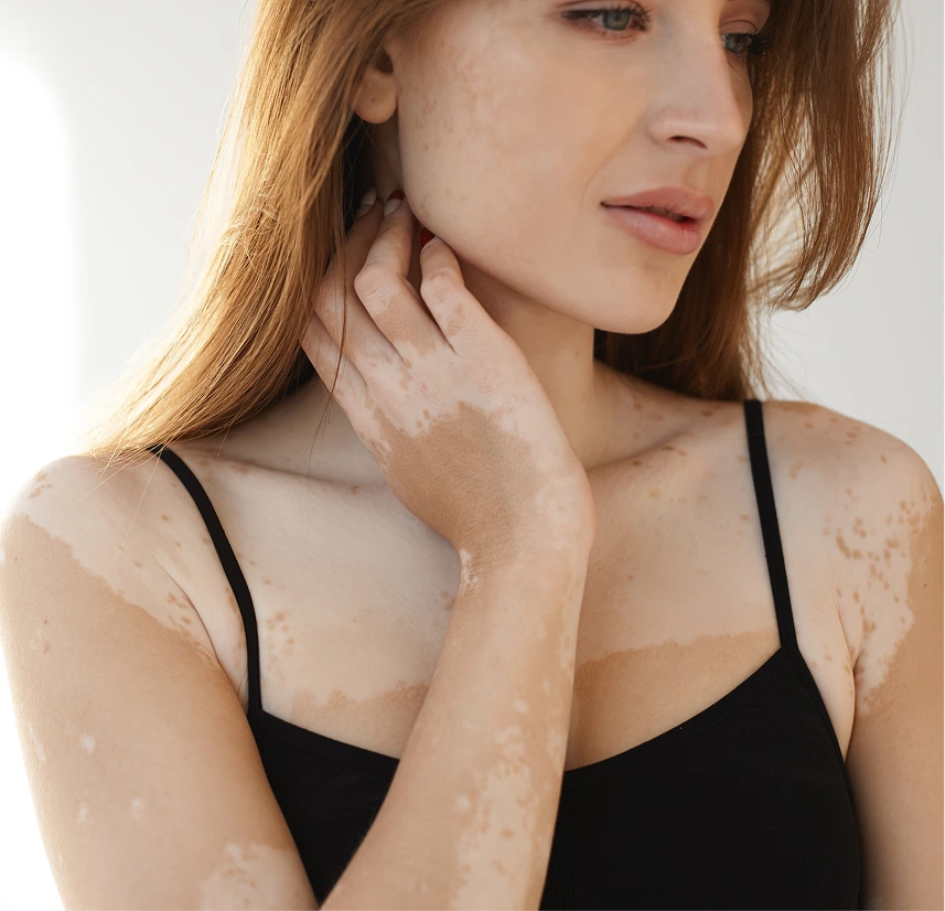 Vitiligo Treatment Phoenix, AZ Banner