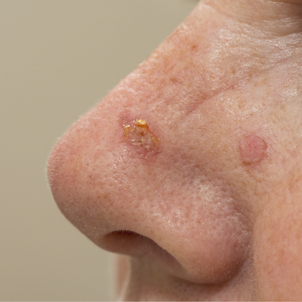 Actinic Keratosis in Phoenix, AZ Banner