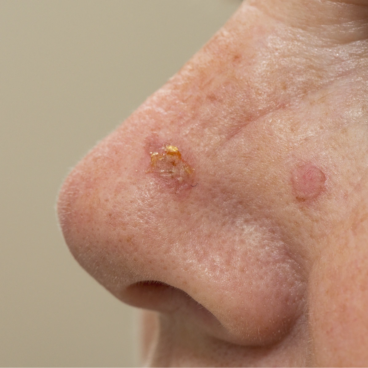 Actinic Keratosis in Phoenix, AZ Banner
