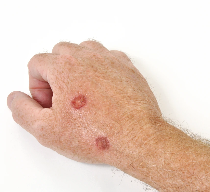 Actinic Keratosis Treatment in Phoenix, AZ Banner