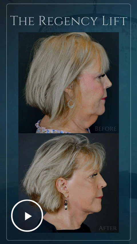 Woman's profile before and after The Regency Lift, showing improved neck and jawline definition