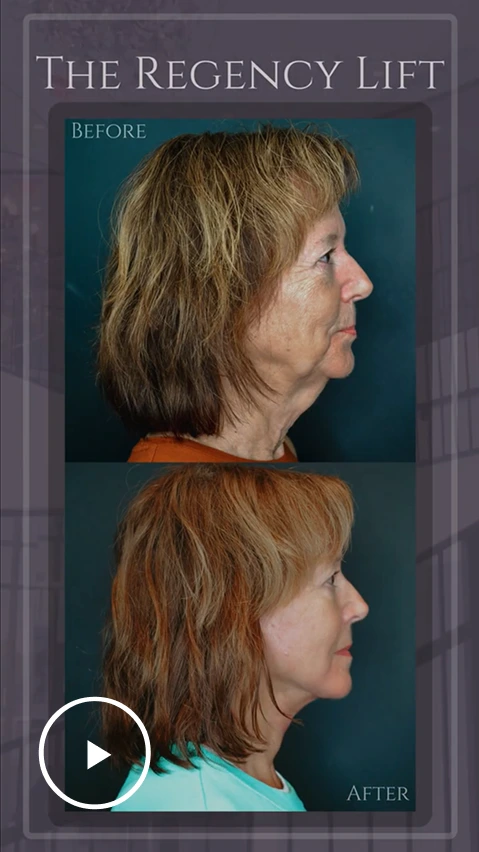 Woman's profile before and after The Regency Lift, showing lifted jawline and reduced sagging