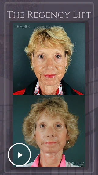 The Regency Lift before and after facelift results showing woman's face pre and post-procedure