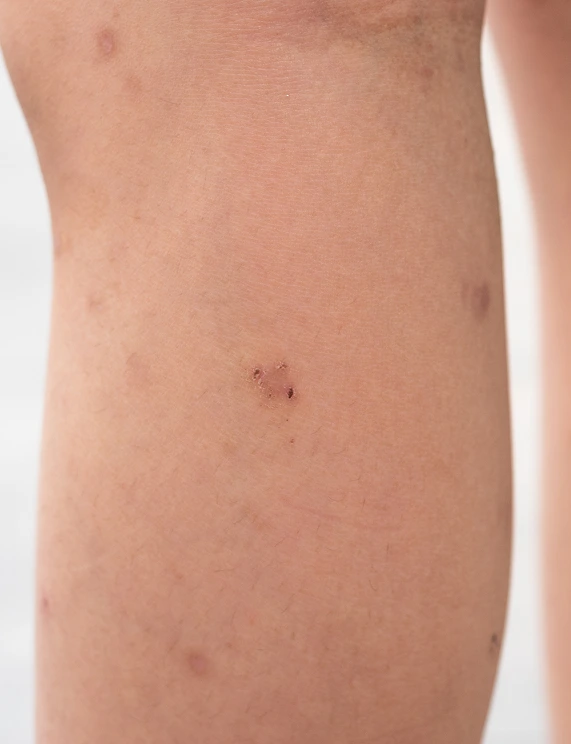 Phoenix, AZ Actinic Keratosis Care Banner