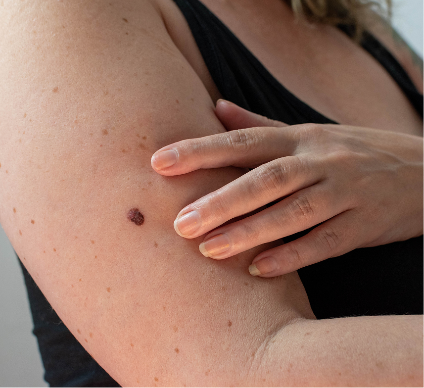 Skin Cancer Screening Services in Phoenix, AZ Banner