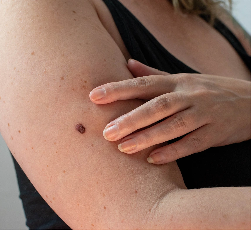 Skin Cancer Screening Services in Phoenix, AZ Banner