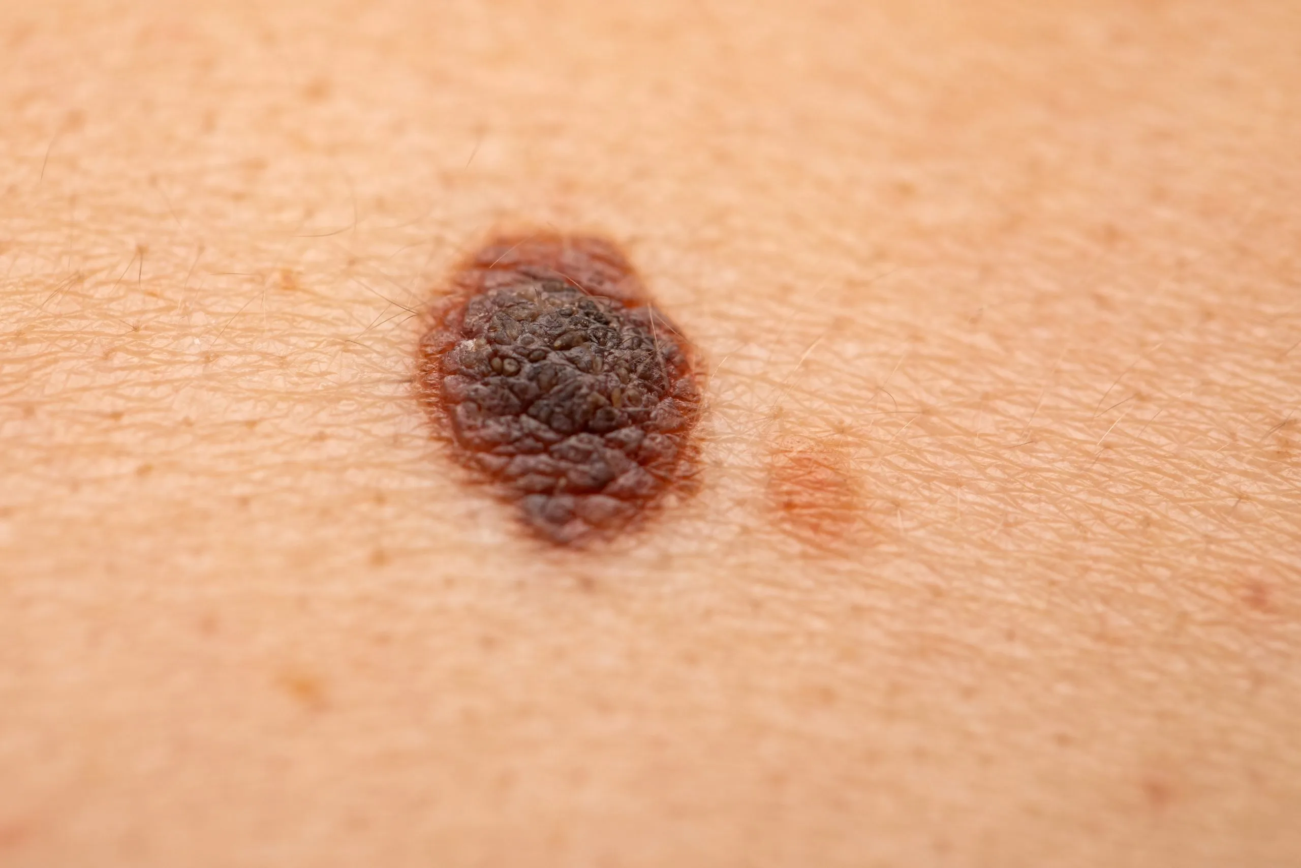 Close-up of dark brown mole on human skin